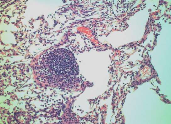Lymphoid follicle lung